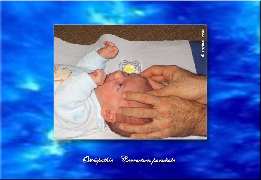 Ostéopathie : Correction pariétale - soin à un nourrisson.